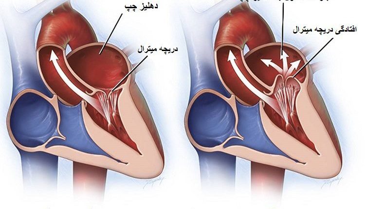 افتادگی دریچه میترال