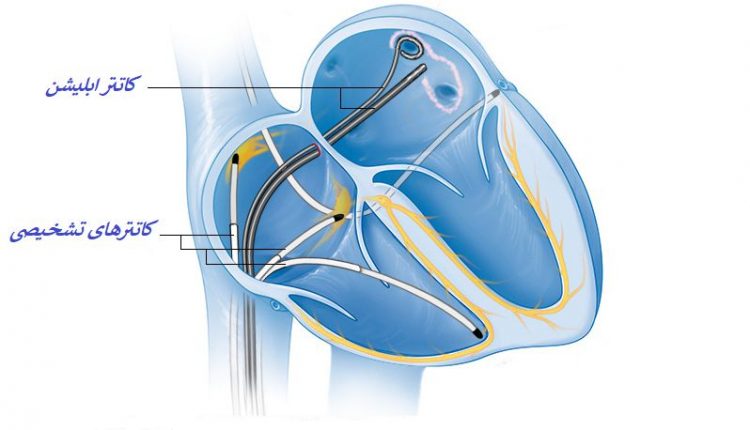 ابلیشن قلبی