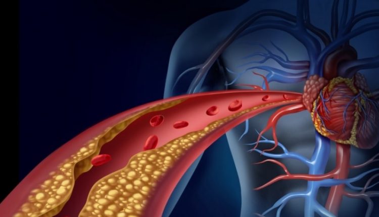 آترواسکلروز