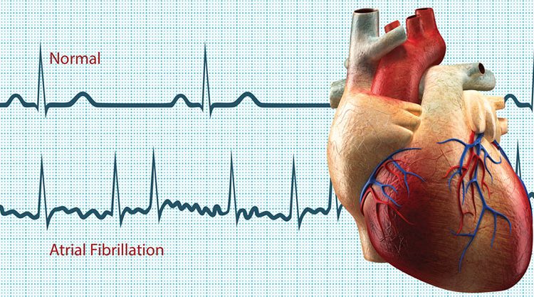 فیبریلاسیون دهلیزی