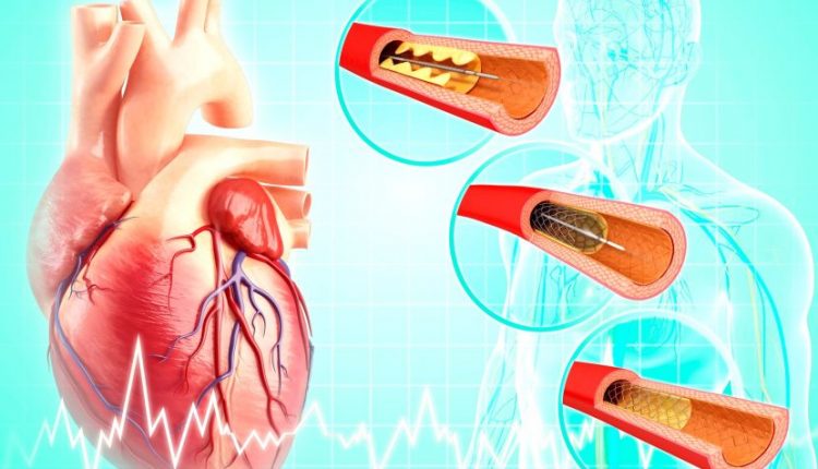 آنژیوپلاستی