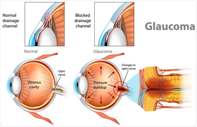منع مصرف پروپرانولول برای بیماران گلوکوما - فشار چشم