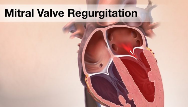 نارسایی دریچه میترال