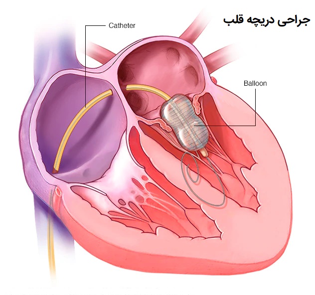 جراحی دریچه قلب