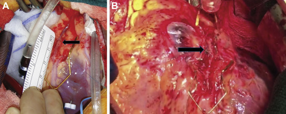 عمل جراحی پل میوکارد