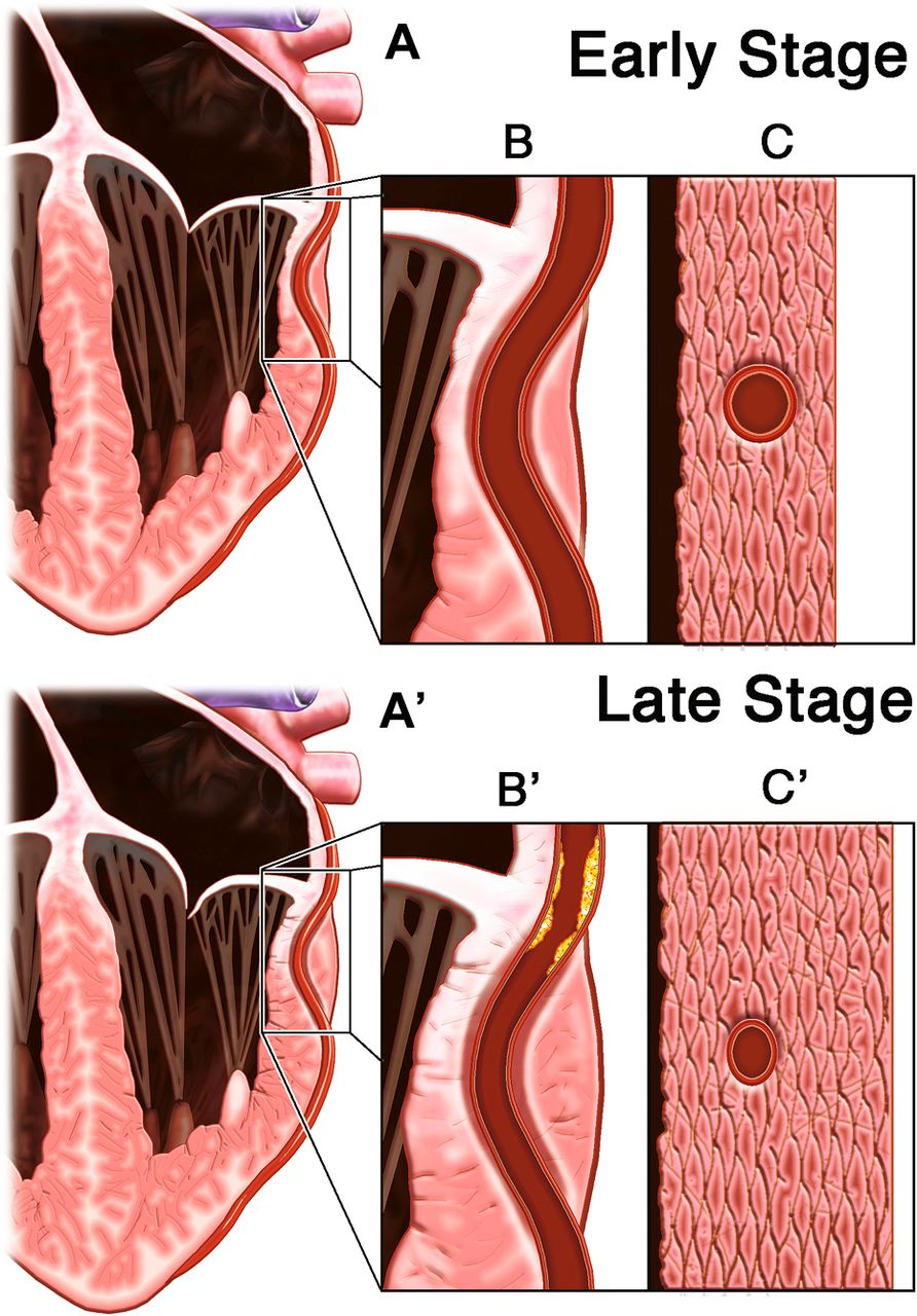 پل میوکارد یا ماسل بریج