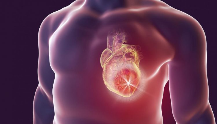 بیماری پل میوکارد یا ماسل بریج