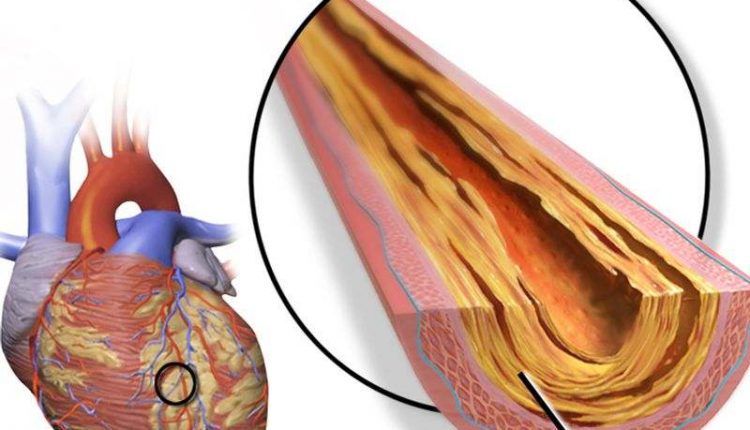 گرفتگی رگ قلب