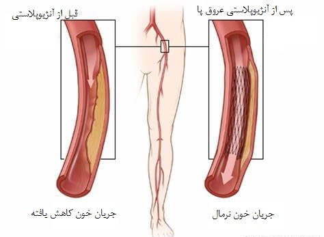 قبل و بعد از آنژیوپلاستی عروق پا